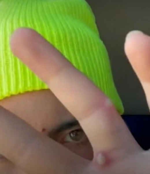 Что делает оспа обезьян с лицом. Фото пациентов Что делает оспа обезьян с лицом. Фото пациентов