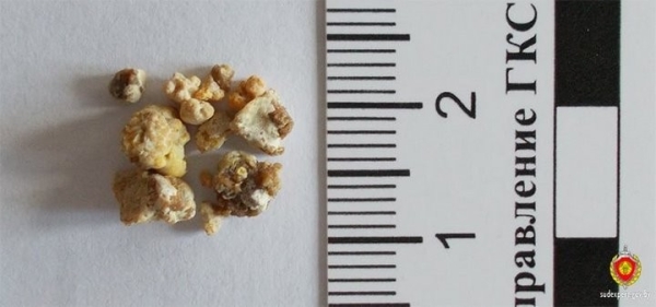 Брестские судебные эксперты помогают людям с мочекаменной болезнью