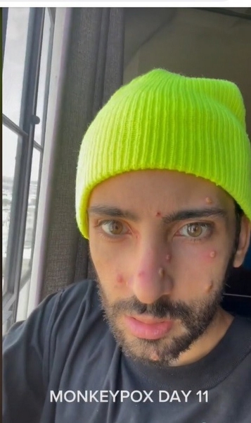 Что делает оспа обезьян с лицом. Фото пациентов Что делает оспа обезьян с лицом. Фото пациентов