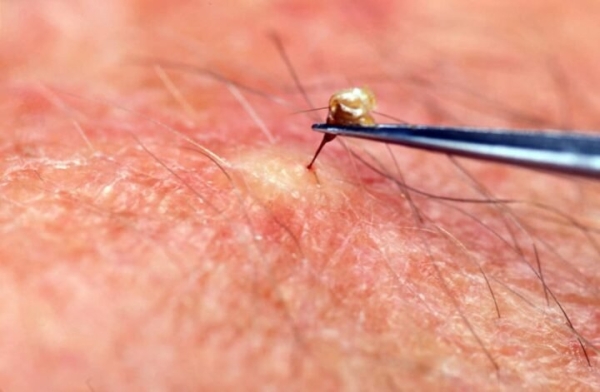 Житель Каменецкого района умер от укуса жалящего насекомого Житель Каменецкого района умер от укуса жалящего насекомого